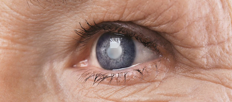 Close-up of elderly woman’s eye showing cloudy lens and wrinkles, representing vision loss and retinal degeneration in Retinitis Pigmentosa