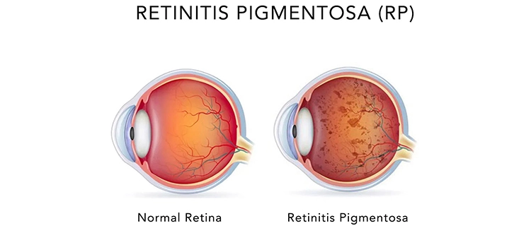Retinitis-Pigmentosa