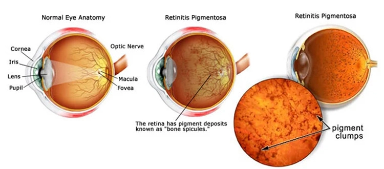 retinitis pigmentosa